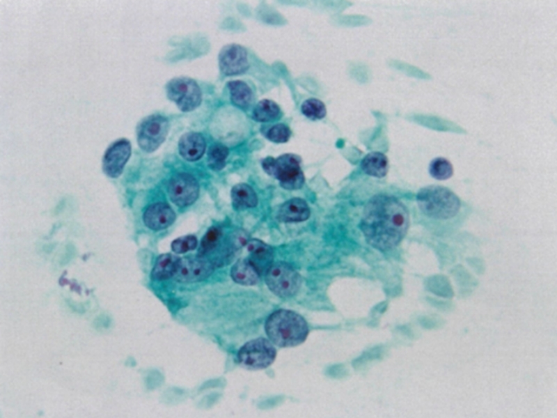腺癌細胞